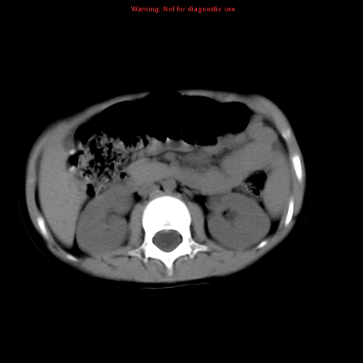 File:Bronchogenic cyst (Radiopaedia 9372-10063 Axial non-contrast 22).jpg