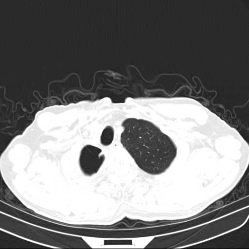 Bronchopleural fistula - postoperative complication (Radiopaedia 21020-20947 Axial lung window 7).jpg