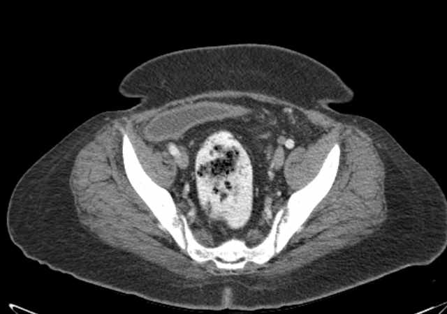Brown tumors compressing the spinal cord (Radiopaedia 68442-77988 E 103).jpg