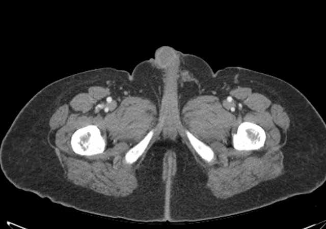Brown tumors compressing the spinal cord (Radiopaedia 68442-77988 E 140).jpg