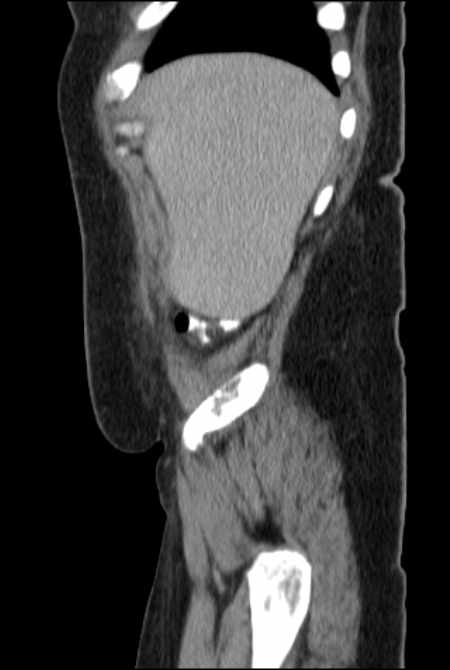 Brown tumors compressing the spinal cord (Radiopaedia 68442-77988 F 9).jpg
