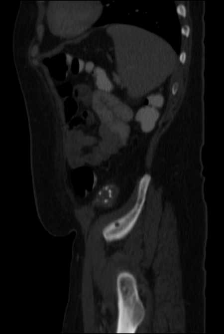 Brown tumors compressing the spinal cord (Radiopaedia 68442-77988 H 45).jpg