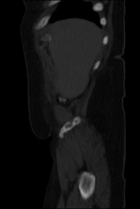 Brown tumors compressing the spinal cord (Radiopaedia 68442-77988 H 8).jpg