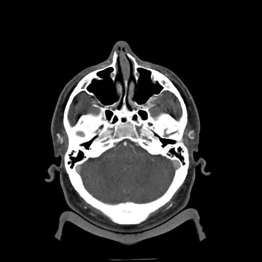 Buccal fat pad arteriovenous malformation (Radiopaedia 70936-81144 A 39).jpg