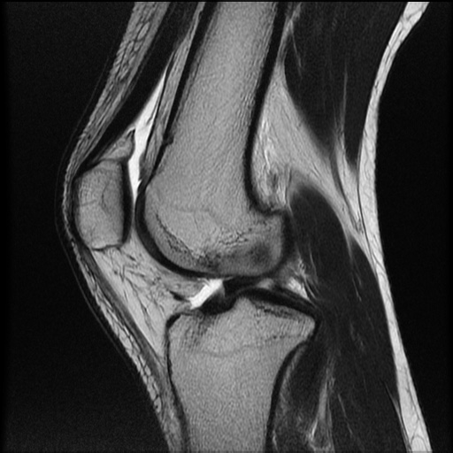 File:Bucket-handle meniscus tear (Radiopaedia 65700-74809 Sagittal T2 15).jpg