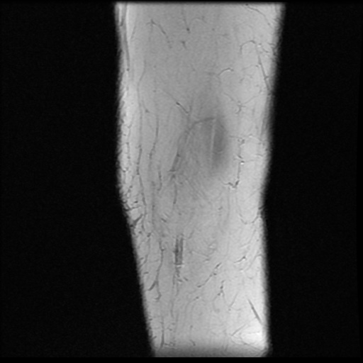 File:Bucket handle meniscus tear (Radiopaedia 56916-63751 Sagittal T2 20).jpg
