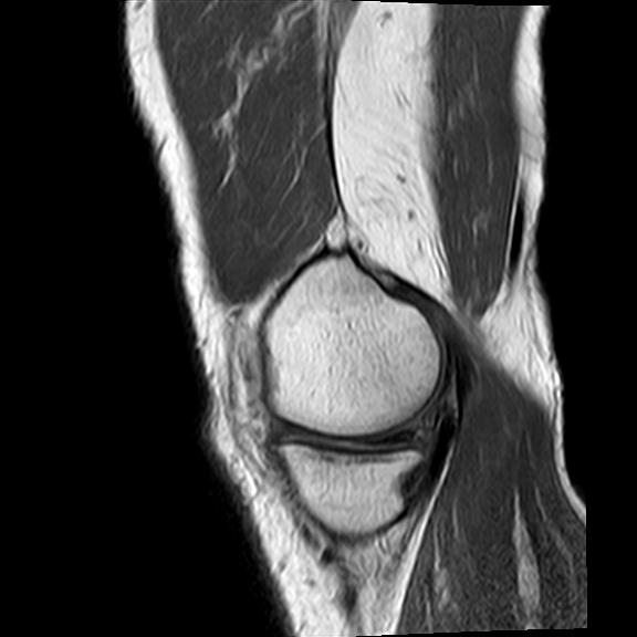 File:Bucket handle tear - medial meniscus (Radiopaedia 29250-29664 Sagittal PD 18).jpg