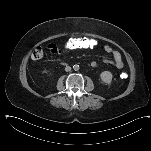 File:Buried bumper syndrome - gastrostomy tube (Radiopaedia 63843-72577 Axial Inject 57).jpg