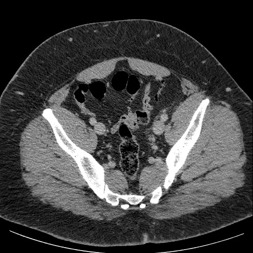 Burned-out testicular seminoma - retroperitoneal nodal metastases (Radiopaedia 62872-71245 A 61).jpg