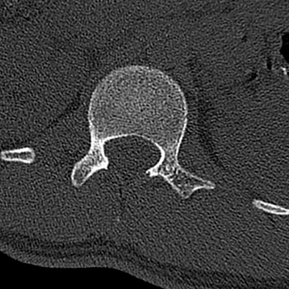 Burst fracture (Radiopaedia 53373-59357 Axial bone window 9).jpg