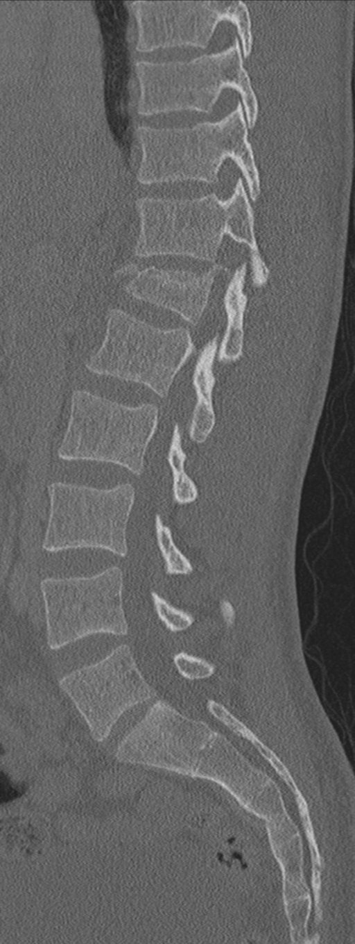 Burst fracture - T12 with conus compression (Radiopaedia 56825-63647 Sagittal bone window 48).png