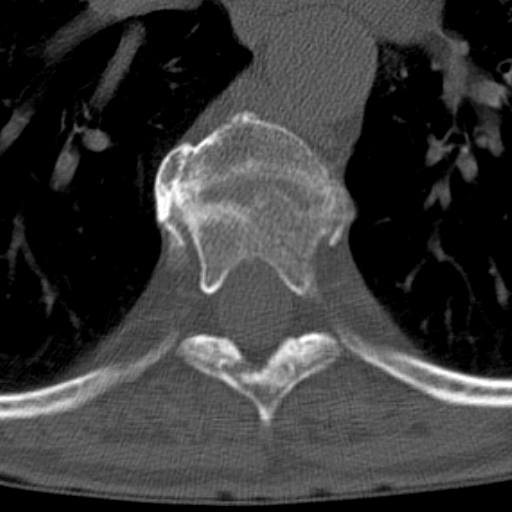 Butterfly vertebrae with kyphoscoliosis (Radiopaedia 14257-14133 Axial bone window 19).jpg