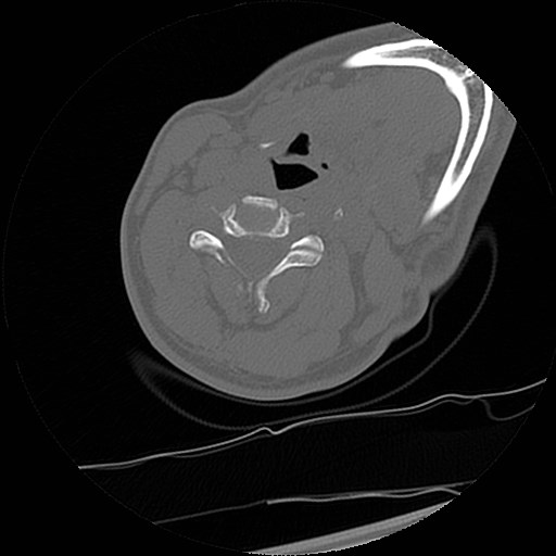 C1-C2 "subluxation" - normal cervical anatomy at maximum head rotation (Radiopaedia 42483-45607 Axial non-contrast 10).jpg