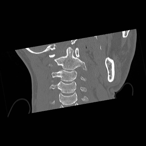 C1-C2 "subluxation" - normal cervical anatomy at maximum head rotation (Radiopaedia 42483-45607 Coronal non-contrast 23).jpg