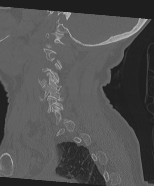 C2 fracture with vertebral artery dissection (Radiopaedia 37378-39199 Sagittal bone window 23).png