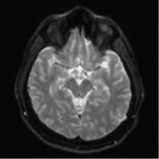 File:CNS vasculitis (Radiopaedia 55715-62263 Axial DWI 12).png