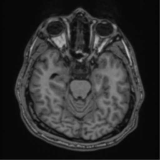 CNS vasculitis (Radiopaedia 55715-62263 Axial T1 4).png