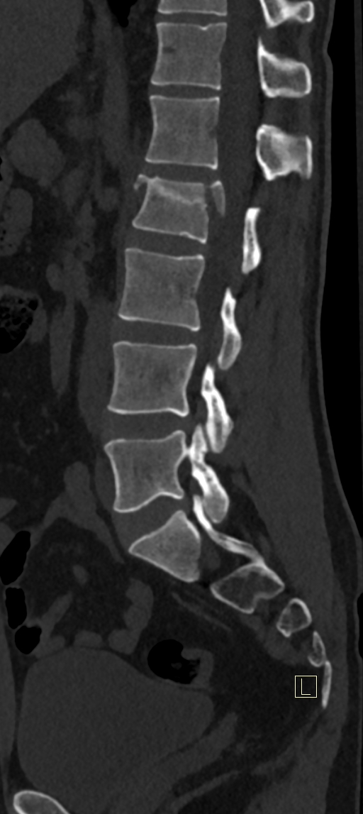 Calcaneal fractures with associated L2 burst fracture (Radiopaedia 71671-82493 Sagittal bone window 33).jpg