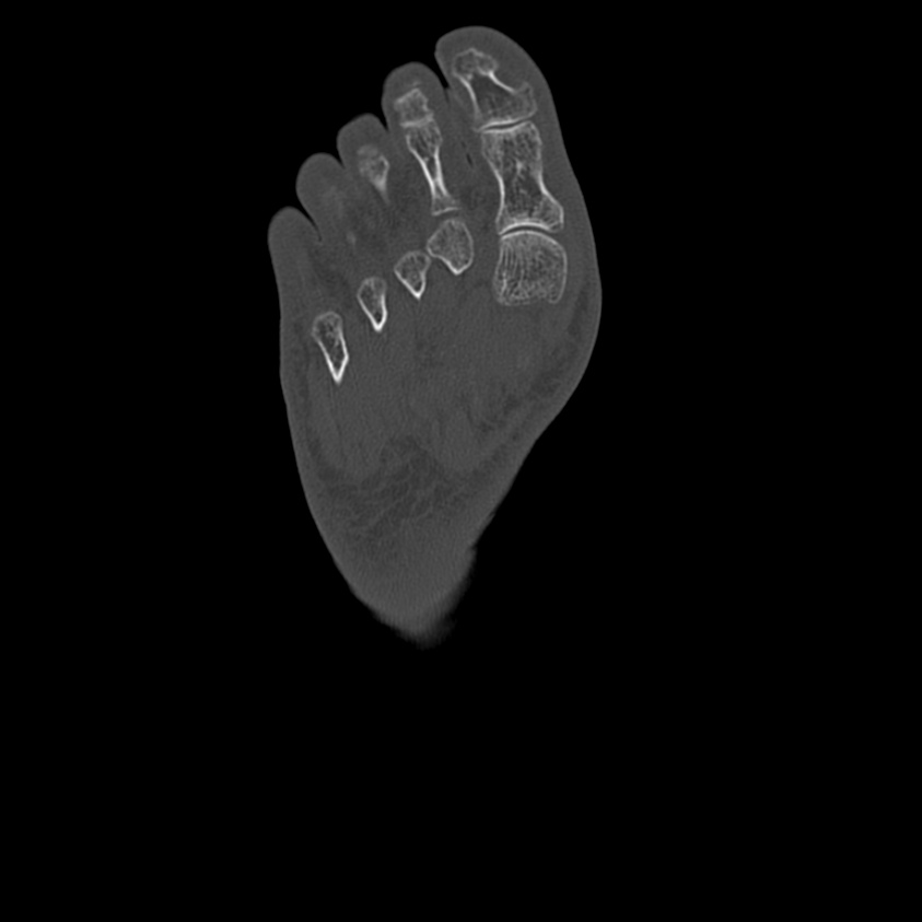 Calcaneal tuberosity avulsion fracture (Radiopaedia 22649-22668 Axial bone window 50).jpg