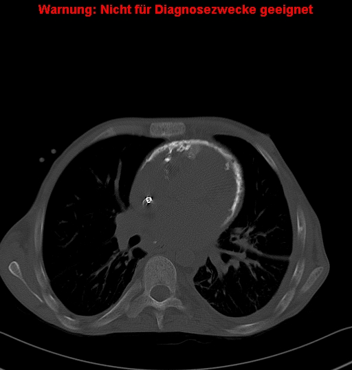 File:Calcific constrictive pericarditis (Radiopaedia 24701-24967 Axial bone window 11).jpg