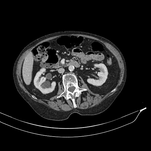 Calcified adrenal glands and Spigelian hernia (Radiopaedia 49741-54988 A 91).jpg