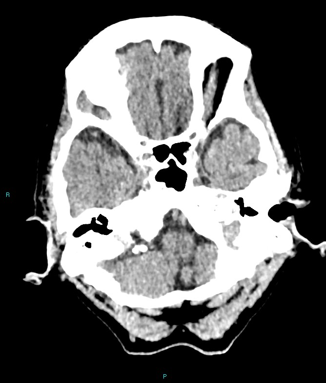 Calcified cerebral emboli from left ventricular thrombus (Radiopaedia 84420-99758 Axial non-contrast 75).jpg
