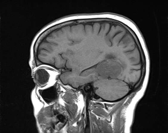 File:Calcified cerebral hydatid cyst (Radiopaedia 65603-74699 Sagittal T1 6).jpg