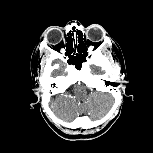 Calcified cerebral hydatid cyst (Radiopaedia 65603-74717 Axial with contrast 9).jpg