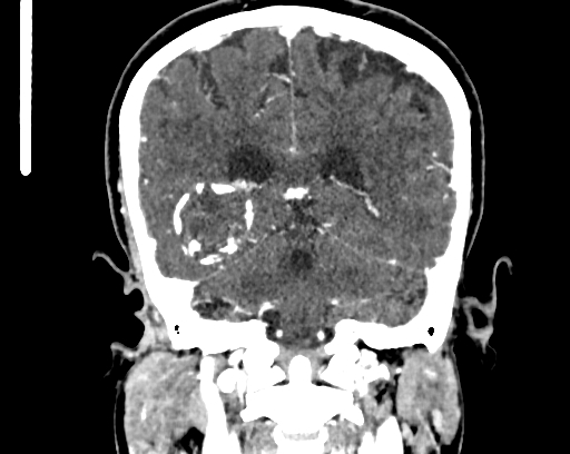 Calcified cerebral hydatid cyst (Radiopaedia 65603-74717 C 48).jpg