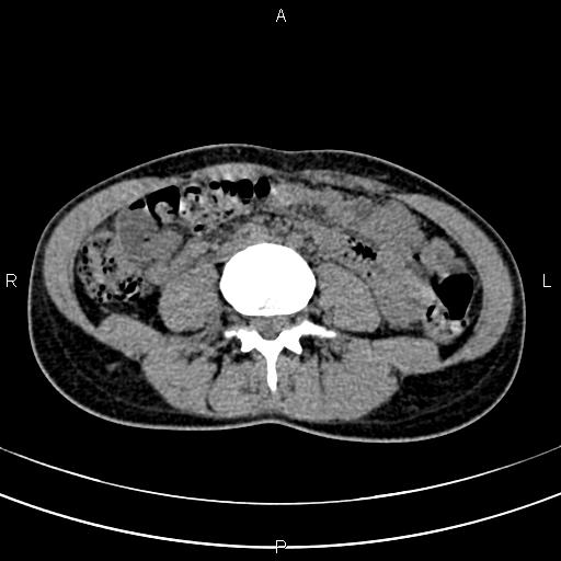 File:Calcified hepatic hydatid cyst (Radiopaedia 83870-99072 Axial non-contrast 105).jpg