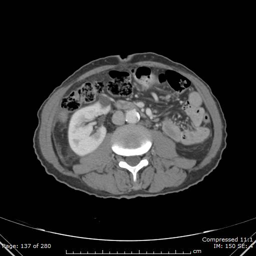 Calcified liver metastases (Radiopaedia 44699-48470 B 49).jpg