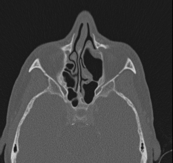 Caldwell-Luc operation (Radiopaedia 52329-58225 Axial bone window 28).jpg