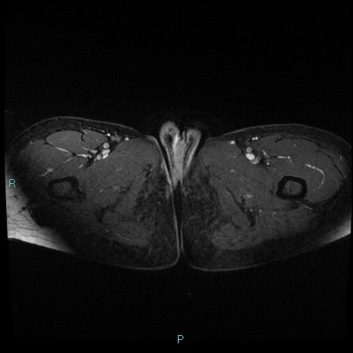 File:Canal of Nuck cyst (Radiopaedia 55074-61448 Axial T1 C+ fat sat 63).jpg
