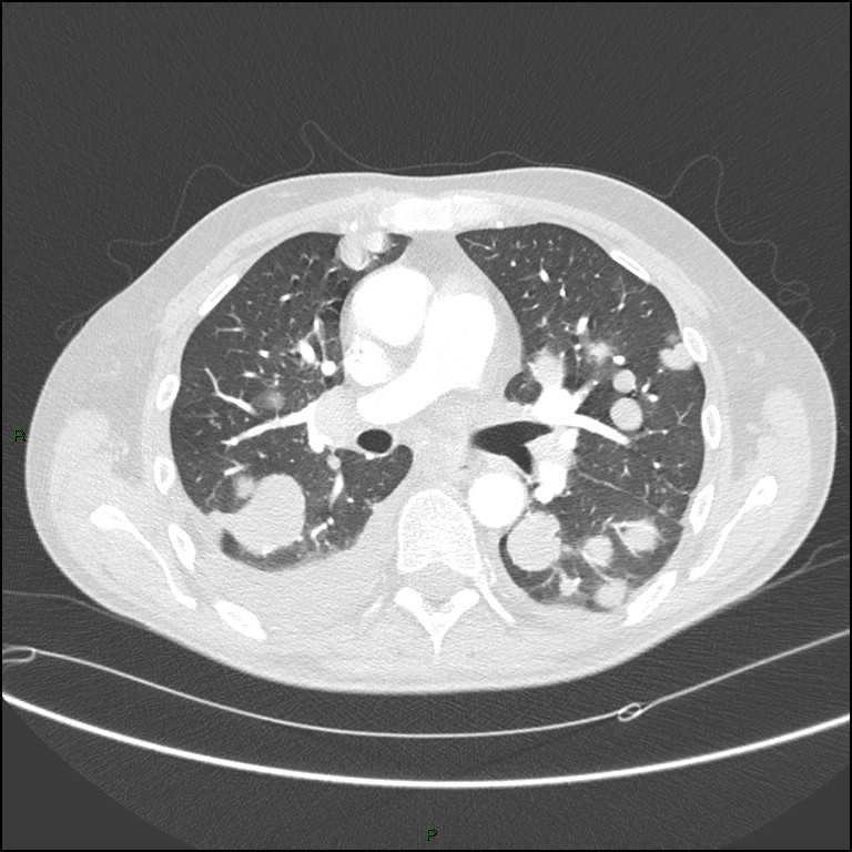 Cannonball metastases (Radiopaedia 82110-96150 Axial lung window 93).jpg