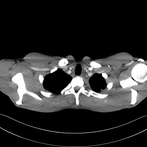 Cannonball metastases - testicular choriocarcinoma (Radiopaedia 84510-99891 B 22).jpg
