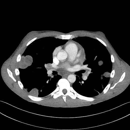 Cannonball metastases - testicular choriocarcinoma (Radiopaedia 84510-99891 B 60).jpg