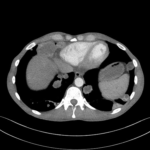 Cannonball metastases - testicular choriocarcinoma (Radiopaedia 84510-99891 B 88).jpg