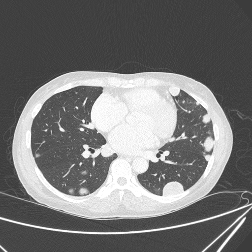 Canonball lung metastasis (Radiopaedia 77634-89837 Axial lung window 105).jpg