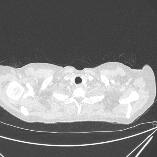 Canonball lung metastasis (Radiopaedia 77634-89837 Axial lung window 9).jpg