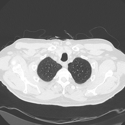 Caplan syndrome (Radiopaedia 56667-63530 Axial lung window 30).jpg