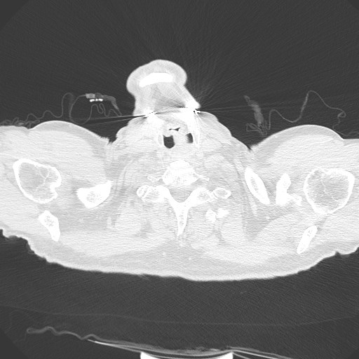 Caplan syndrome (Radiopaedia 56667-63530 Axial lung window 4).jpg