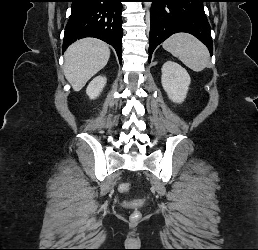 Carcinoid tumor - terminal ileum (Radiopaedia 60931-68739 B 77).jpg