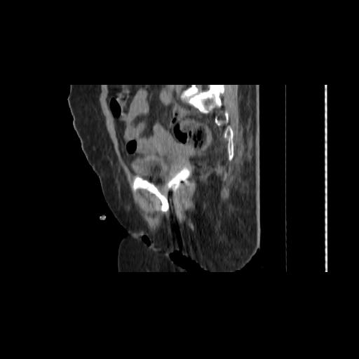 File:Carcinoma cervix- brachytherapy applicator (Radiopaedia 33135-34173 D 67).jpg