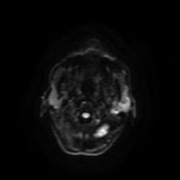 Carcinoma ex-pleomorphic adenoma of parotid (Radiopaedia 28383-28627 Ax DWI B-500 GE 55).jpg