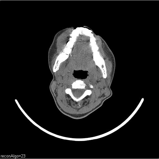 Carcinoma of the maxillary antrum (Radiopaedia 53805-59888 Axial non-contrast 43).jpg