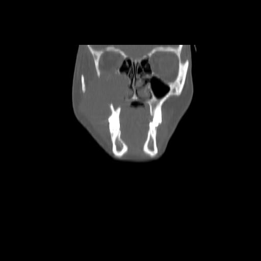 Carcinoma of the maxillary antrum (Radiopaedia 53805-59888 Coronal bone window 35).jpg