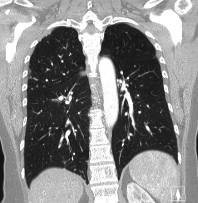 Cardiac sarcoidosis (Radiopaedia 74548-85534 Coronal lung window 47).jpg