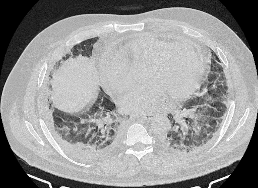 Cardiogenic pulmonary edema (Radiopaedia 68180-77678 Axial lung window 62).jpg