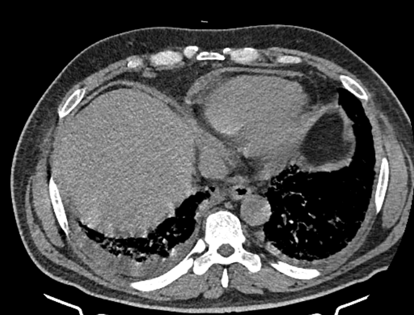 Cardiogenic pulmonary edema (Radiopaedia 68180-77678 Axial non-contrast 42).jpg