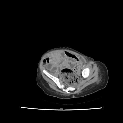 File:Caroli disease with autosomal recessive polycystic kidney disease (ARPKD) (Radiopaedia 89651-106703 B 194).jpg
